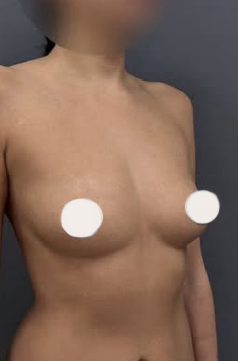 Antes del aumento de senos con implantes Lifesil