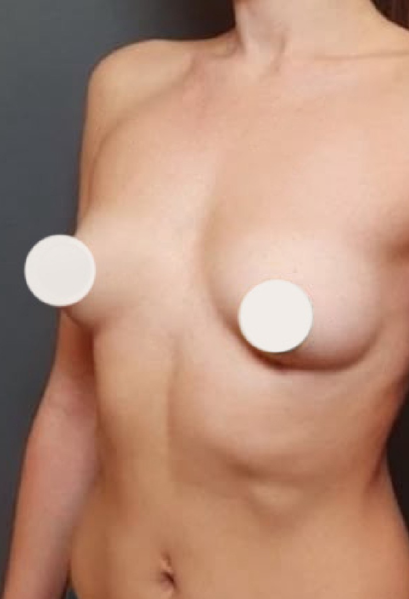 Antes del aumento de senos con implantes Lifesil, caso 2