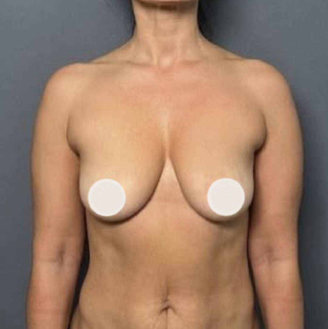 Antes del levantamiento de senos con implantes Lifesil