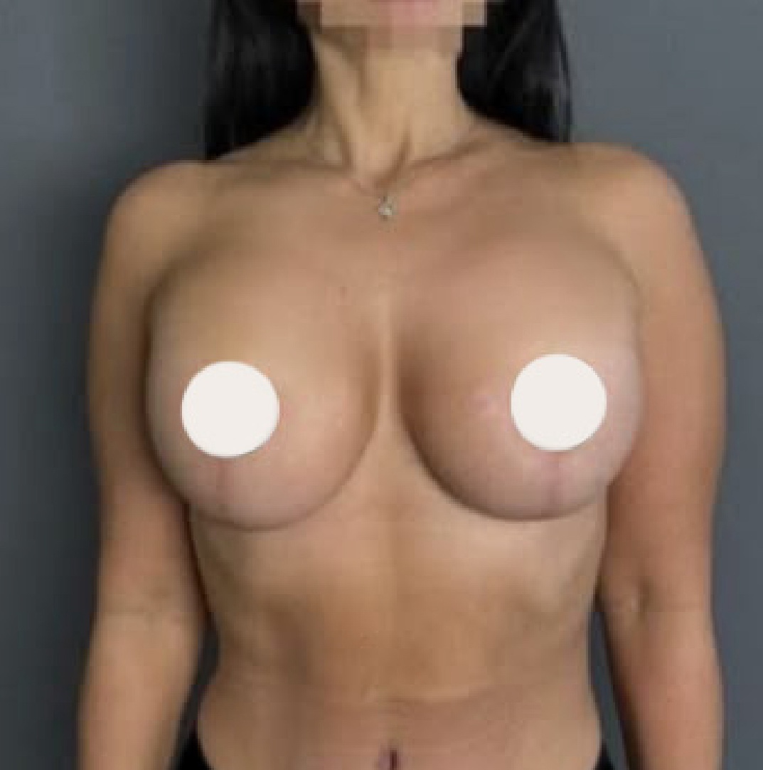 Después del levantamiento de senos con implantes Lifesil
